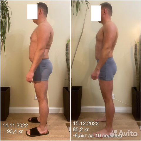 Безоперационная липосакция